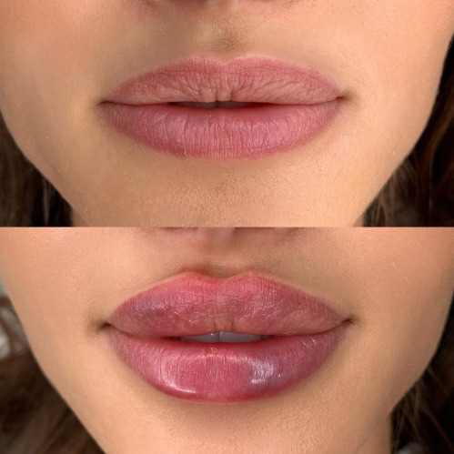Advanced Lip filler Injection training