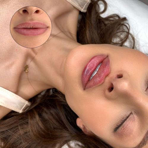 Advanced Lip filler Injection training
