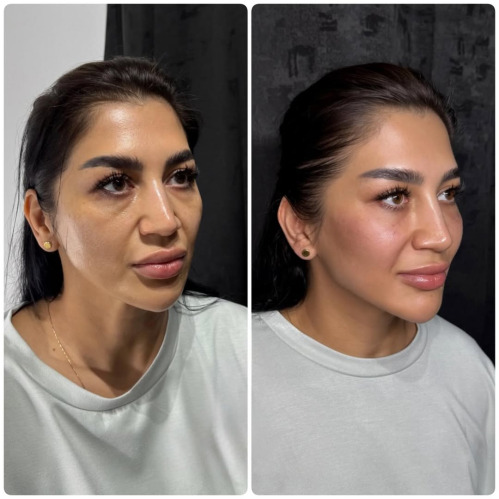 Dermal Filler Training