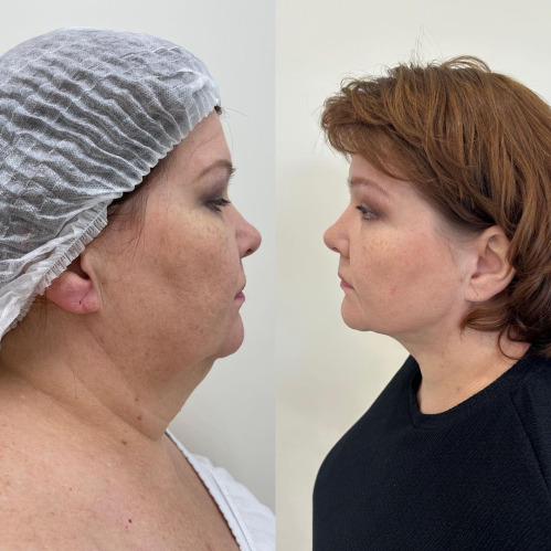 Face Lipo 3 Training