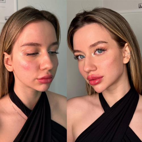 Dermal Filler Training