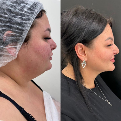 Face Lipo 3 Training