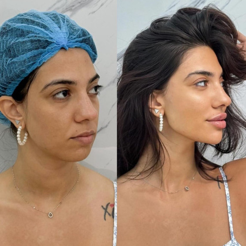 Dermal Filler Training