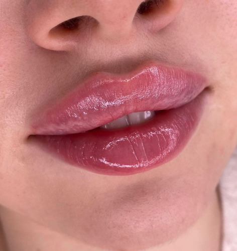 Advanced Lip filler Injection training