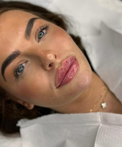 Advanced Lip filler Injection training