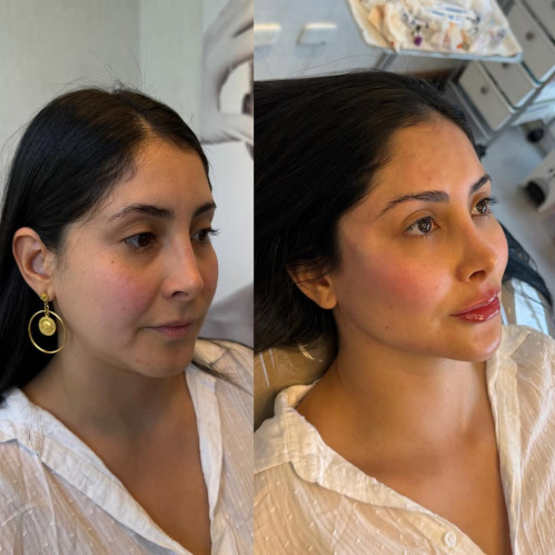 Dermal Filler Training