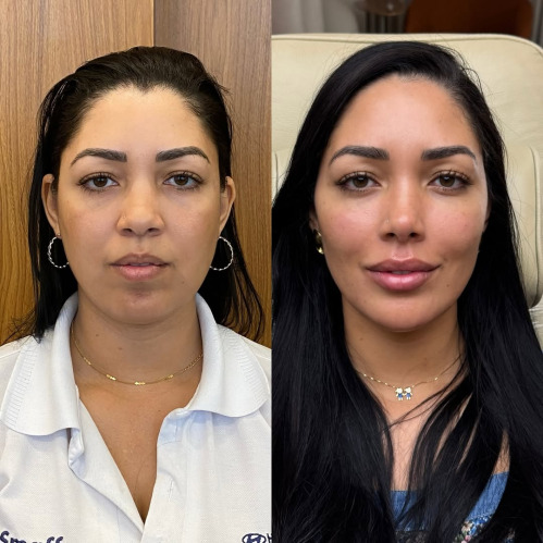 Dermal Filler Training