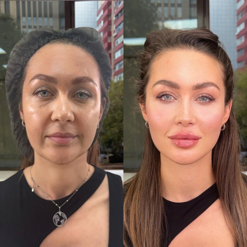 Dermal Filler Training