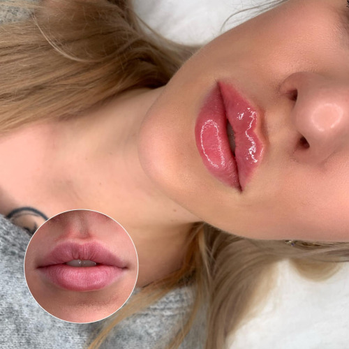 Advanced Lip filler Injection training