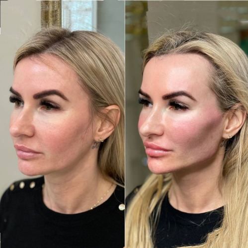 Dermal Filler Training