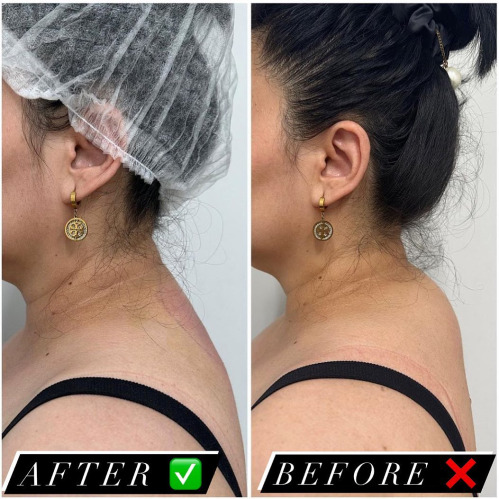 Face Lipo 3 Training