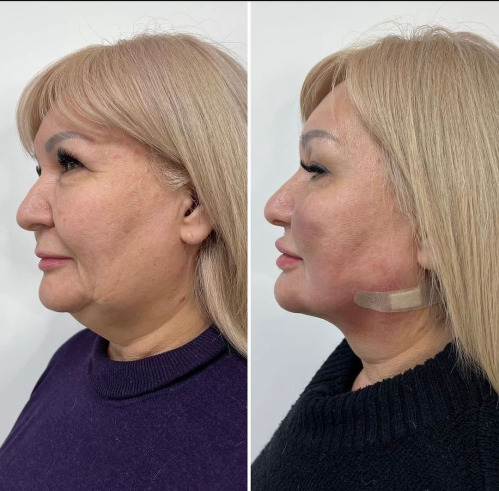 Face Lipo 3 Training