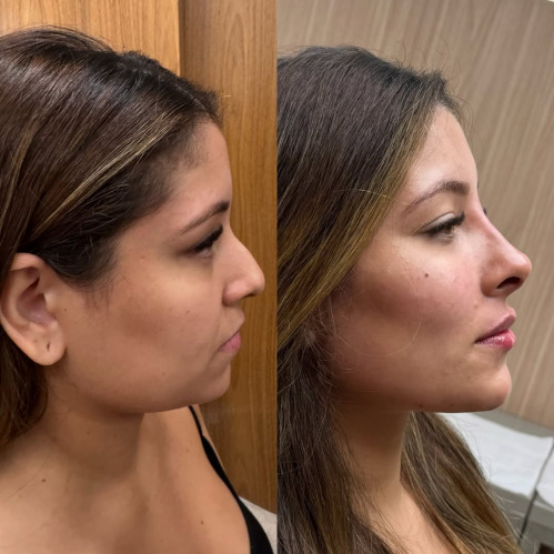 Dermal Filler Training