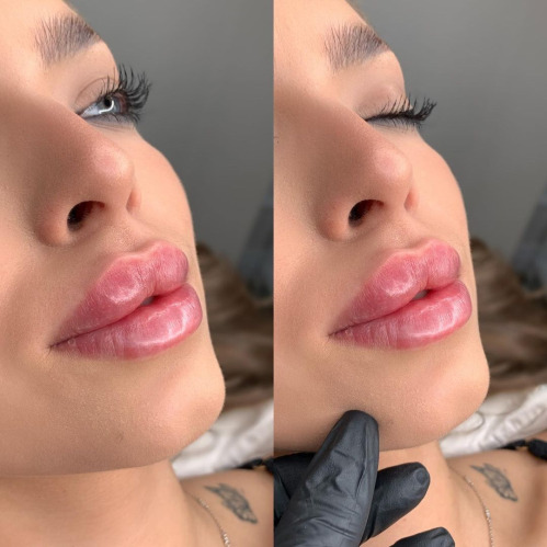 Advanced Lip filler Injection training